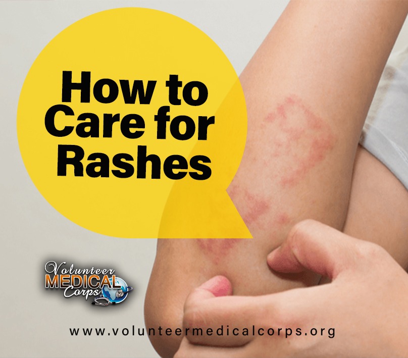HOW TO CARE FOR RASHES